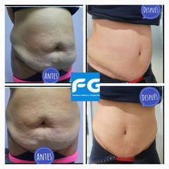 Abdominoplastia - Dr. Gastón Eduardo Ferreira