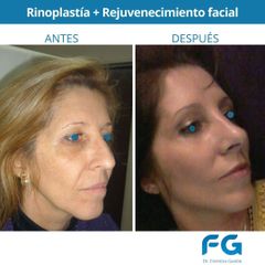 Rinoplastia - Dr. Gastón Eduardo Ferreira