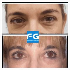 Blefaroplastia - Dr. Gastón Eduardo Ferreira