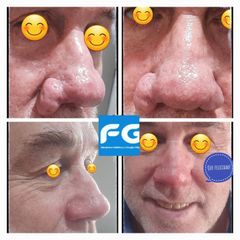 Rinoplastia - Dr. Gastón Eduardo Ferreira