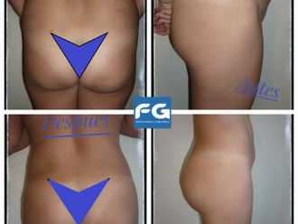 Aumento glúteos antes y después - 859808
