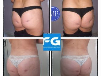 Aumento glúteos antes y después - 859809