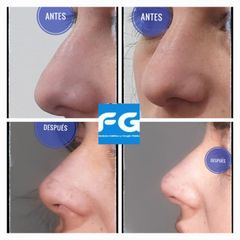 Rinoplastia - Dr. Gastón Eduardo Ferreira