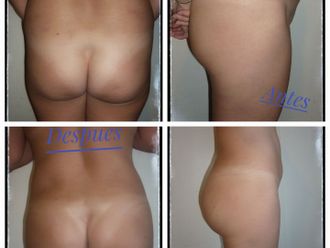 Aumento glúteos antes y después - 861043