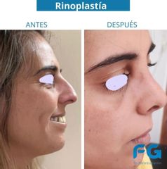 Rinoplastia - Dr. Gastón Eduardo Ferreira