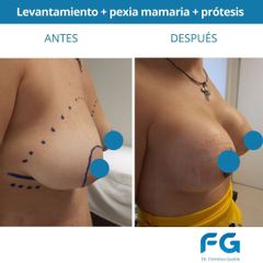 Mastopexia - Dr. Gastón Eduardo Ferreira