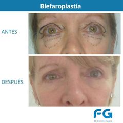 Blefaroplastia - Dr. Gastón Eduardo Ferreira
