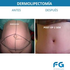 Dermolipectomía - Dr. Gastón Eduardo Ferreira