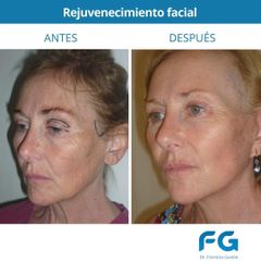 Rejuvenecimiento facial - Dr. Gastón Eduardo Ferreira