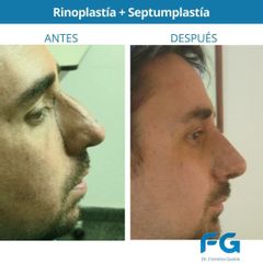Rinoplastia - Dr. Gastón Eduardo Ferreira