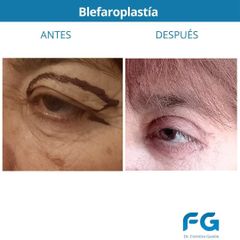 Blefaroplastia - Dr. Gastón Eduardo Ferreira