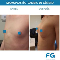 Aumento mamas - Dr. Gastón Eduardo Ferreira