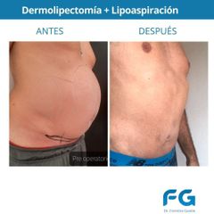 Dermolipectomía - Dr. Gastón Eduardo Ferreira