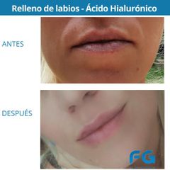 Relleno de labios - Dr. Gastón Eduardo Ferreira