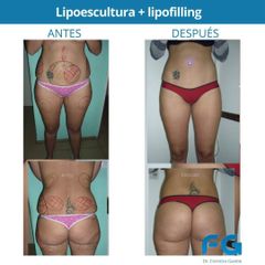 Lipoescultura - Dr. Gastón Eduardo Ferreira