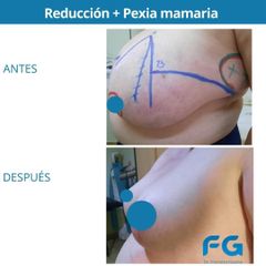 Reducción mamas - Dr. Gastón Eduardo Ferreira