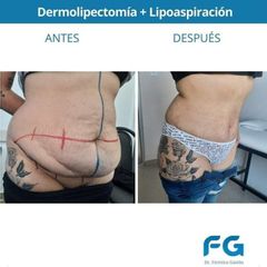 Dermolipectomía - Dr. Gastón Eduardo Ferreira