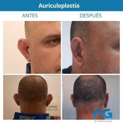 Otoplastia - Dr. Gastón Eduardo Ferreira
