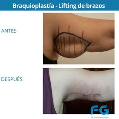 Braquioplastia - Dr. Gastón Eduardo Ferreira