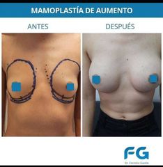Aumento mamas - Dr. Gastón Eduardo Ferreira