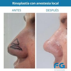 Rinoplastia - Dr. Gastón Eduardo Ferreira