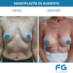 Aumento mamas - Dr. Gastón Eduardo Ferreira