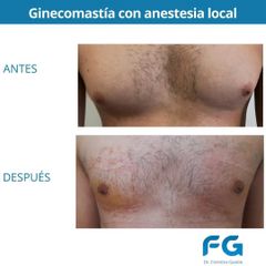 Ginecomastia - Dr. Gastón Eduardo Ferreira