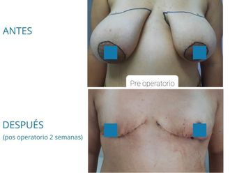 Reasignación de sexo antes y después - 861068