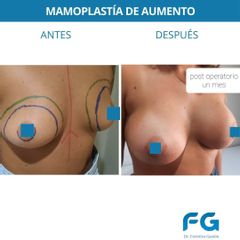 Aumento mamas - Dr. Gastón Eduardo Ferreira