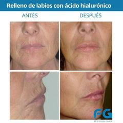 Relleno de labios - Dr. Gastón Eduardo Ferreira