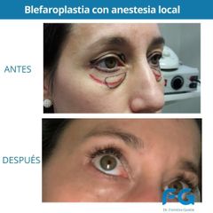 Blefaroplastia - Dr. Gastón Eduardo Ferreira