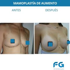 Aumento mamas - Dr. Gastón Eduardo Ferreira