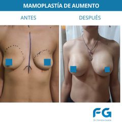 Aumento mamas - Dr. Gastón Eduardo Ferreira