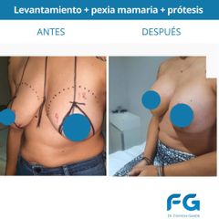 Mastopexia - Dr. Gastón Eduardo Ferreira
