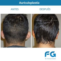 Otoplastia - Dr. Gastón Eduardo Ferreira