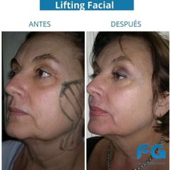Lifting - Dr. Gastón Eduardo Ferreira