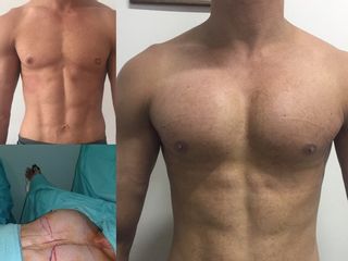 Prótesis de pectorales