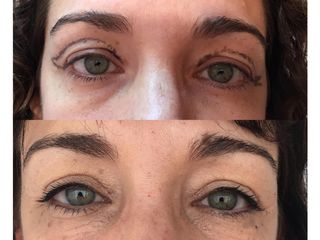 Blefaroplastia