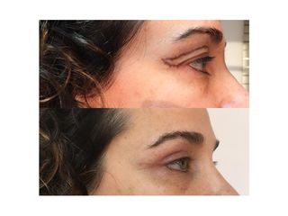 Blefaroplastia