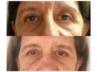 Blefaroplastia