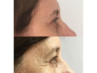 Blefaroplastia