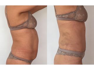 Liposuccion