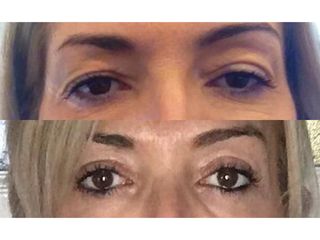 Blefaroplastia