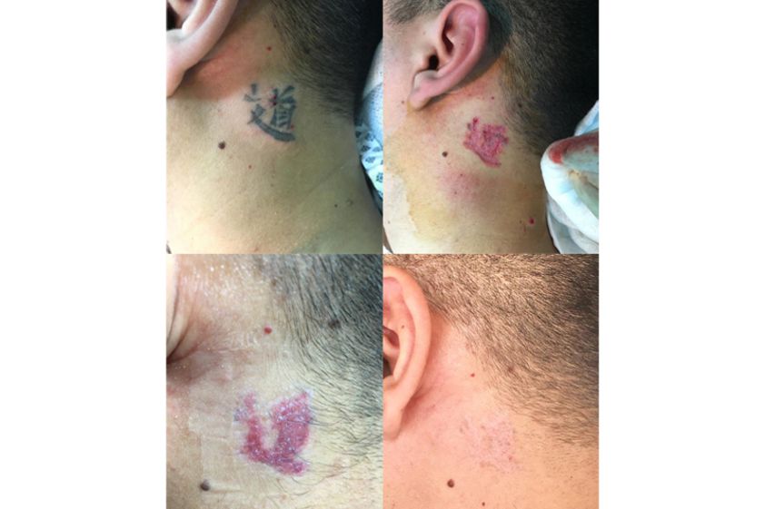 Borrar tatuajes antes y después - 643683