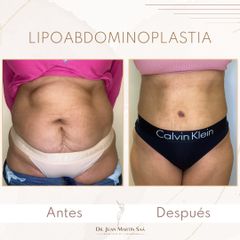 Lipoabdomindoplastia - Dr. Juan Martín Saa