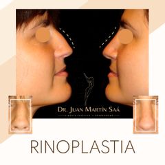 Rinoplastia - Dr. Juan Martín Saa