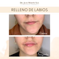 Relleno de labios - Dr. Juan Martín Saa
