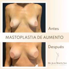 Aumento mamas  - Dr. Juan Martín Saa