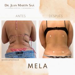 Liposucción - Dr. Juan Martín Saa