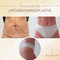 Lipoabdomindoplastia - Dr. Juan Martín Saa